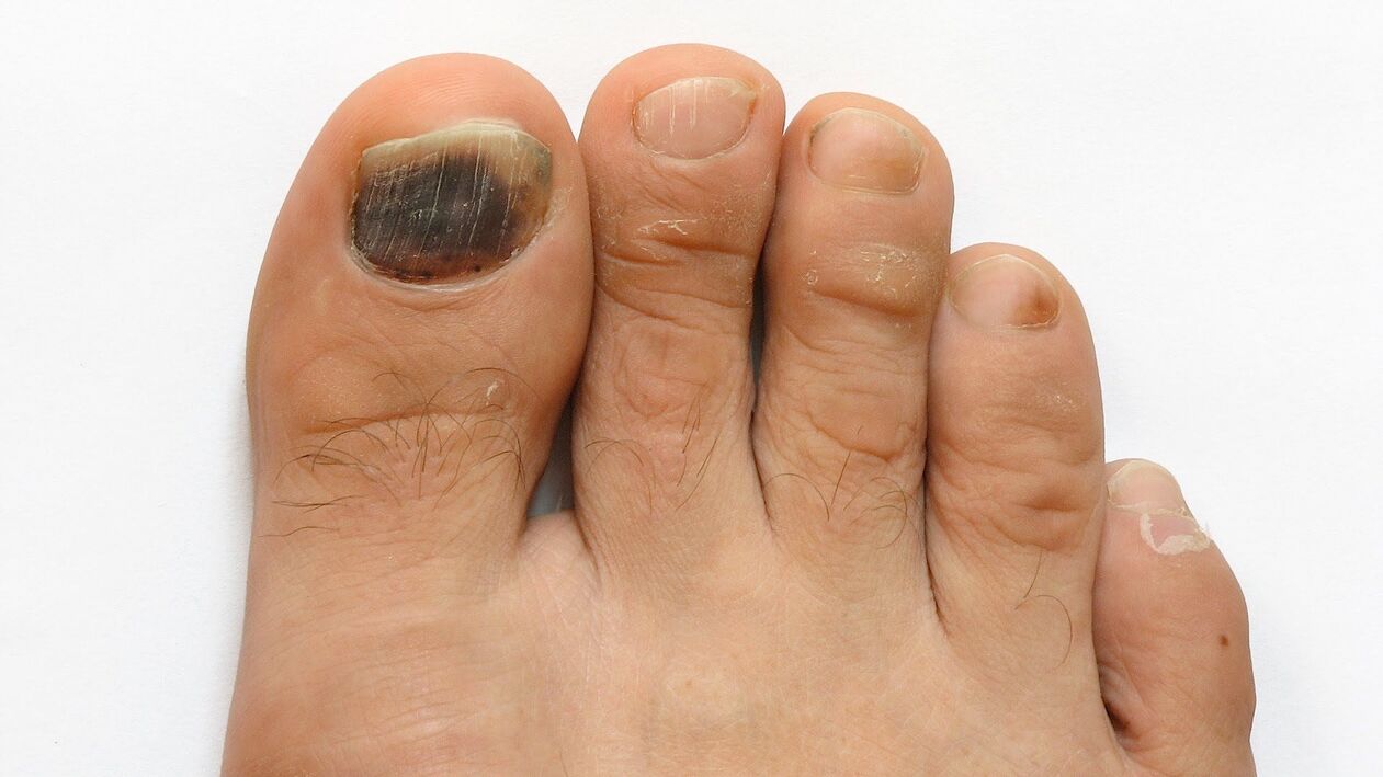 symptoms of fungus on the big toe photo 2