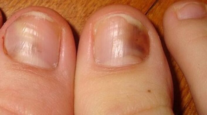 fungal infection of the nail