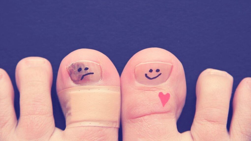 Why nail fungus is dangerous