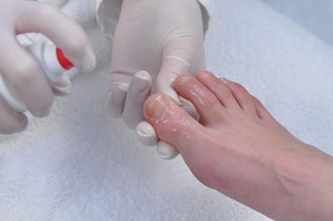 spray for nail fungus treatment