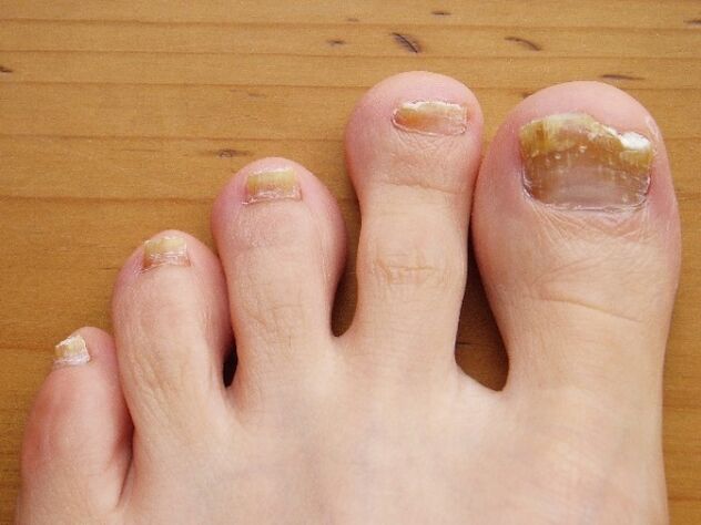damage to the nails with a fungus