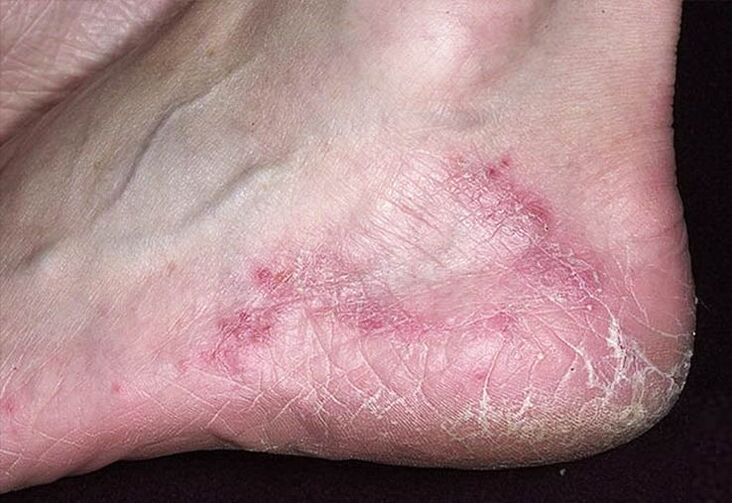 Cracks and redness of the skin on the heels are signs of a fungal infection