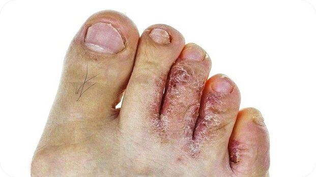 What foot fungus looks like