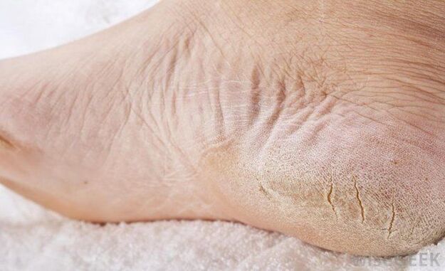 dry feet are a sign of fungus