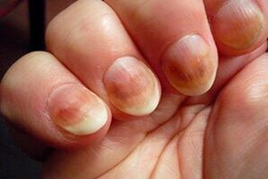 Nail fungus