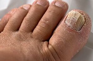 Photo of the nail fungus