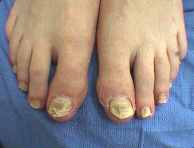 Symptoms of nail mushrooms