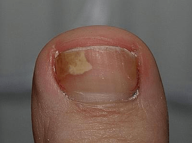 Mushroom on the left side of the nail