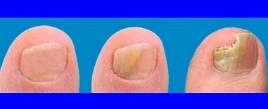 Phase of the development of the mushroom on the fingers of the feet