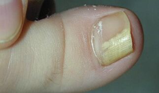 Signs and symptoms of the nail fungus