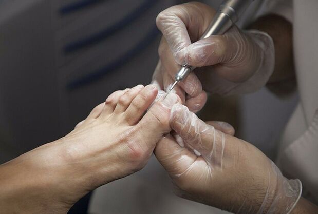 Diagnosis of the mushroom of the legs