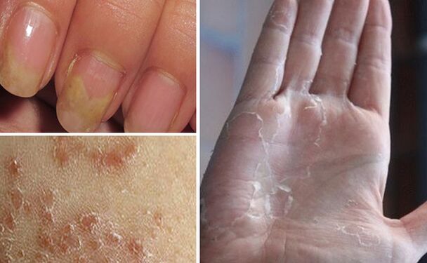 Mycosis can move on to other parts of the body