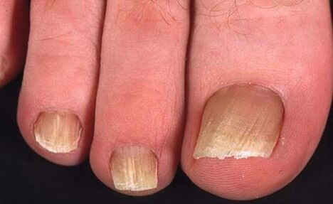 type of toenail fungus