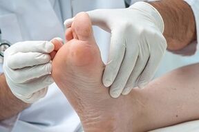 doctor examines feet for fungus on toes