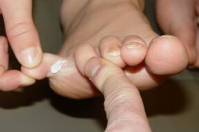 fungus on toes