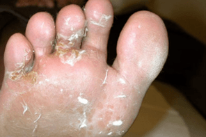 mushrooms on fingers and feet