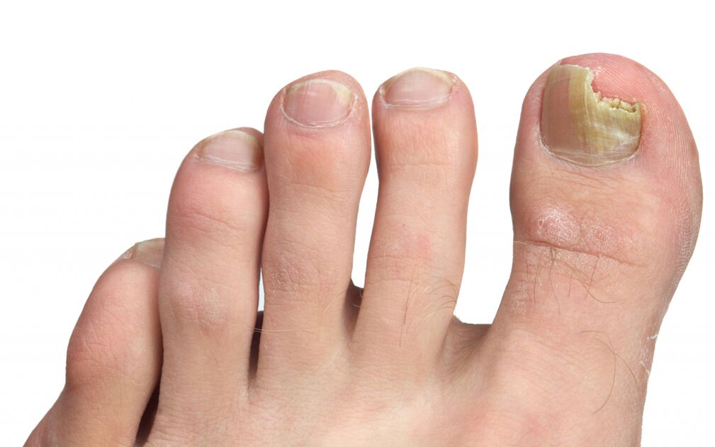 Stages of toenail fungus