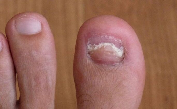 damage to the nail of the big toe with a fungus